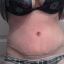 po day 8, with silicone strips on my incision