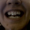 After first aligner