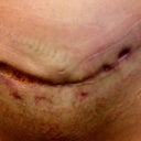 11 weeks post op - you can see my skin is so red from the tape.