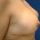 6 days post op