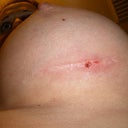 Left breast incision