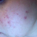 next morning after peel, now these red spots are getting into redish brown color... before peel i had only 2 acne scars on my this cheek