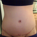 thought I would post a pic of the scar again. I think it looks much better