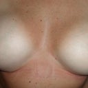 almost 1 month post op