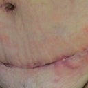 the scar this morning after a shower with Hibiscrub!  I use a fresh wash cloth every wash! this is o my right side as this is taken from a mirror!