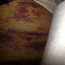 Lipo bruises on torso side.  Day 10