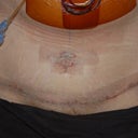 24 Hours Post Op