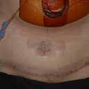 24 Hours Post Op