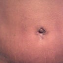 2 weeks using hydroquinone cream (6 weeks post op) and bb tape burn is almost gone completely big improvement cream works