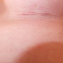 Day 33 Lefty.  You can see the marks from the scar strip.