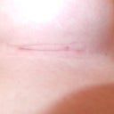 Day 33 Righty.  You can see the marks from the scar strip.