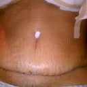 9 days post op tummy tuck scar.....very sad that i still have strech marks but those were all above the bellybutton
