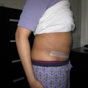 DAY 16 POST OP