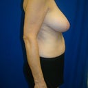 Side view of my sagging, pointy breasts