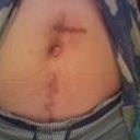 The 2012 healing cut process infection inner starting since 2005;(