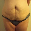 You can see how uneven my stomach is. The deep scar is from my appendix.