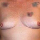 The deflated breast 6 years after my reduction.