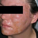 This is right after the procedure. Ouch!!!!!!!!!!!!!!!!!!