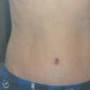 7 Weeks post op