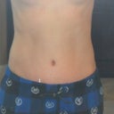 7 Weeks post op