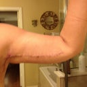 2weeks post op