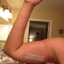 2wks post op