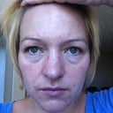 4 Days after first laser treatment