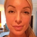 3 week post op front view.. definitely some asymmetrical swelling to match my asymmetrical face lol