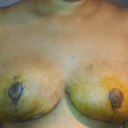16 days post op