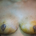 16 days post op