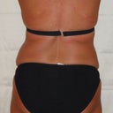 Can't wait to see what the flank lipo does for the love handles!