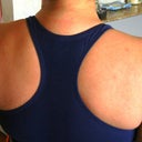 Two days after arm and bra bulge surgery.