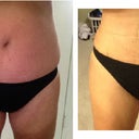 OMG   I love this !!!!   2 weeks exactly from surgery.  This is the first time I tried on my bathing suit.  I'm still super swollen, but man, this is gonna look GOOD !!!