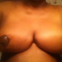 3 day post op. looking good; still a little swollen:)