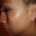 After IPL treatment photo