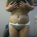 4 days p.o.. pleased how belly button turned out. Hope it sinks in more.
