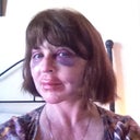 day 4 after surgery...lots of bruising/swelling but no pain at all.  even here you can see that my neck is smooth and firm, my eyes are no longer hooded and my jawline is straight.