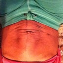 Diastasis recti