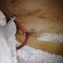 Drainage tube coming out from incision...
