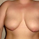 My "before" frontal