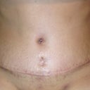 Incision at PO17. the vertical incision was my old BB and now looks like i have 2 BB..