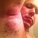 Pic form the morning after. As you can see, the area is quite swollen, but it healed in a couple of days. NO BIG DEAL. The grid is applied with a stencil and each "box" is treated one at a time. The anasthesia took 1/2 hr and the treatment approx 30 min per side. I'm 6'1 and have large armpits