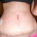 2 weeks post op....still so swollen, i think worse than last week........and yes thats all stretch marks still, not binder marks like a lot of yall...I just had that many that he couldn't even really take a fraction of them....