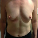 Before - Front Pose