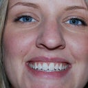 zoom whitening after treatment