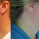 Before and After at 11 weeks post op. LOVE my smooth neck and no more jowels!! Notice how prominent my scars are.