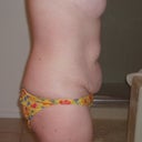 side view before surgery. I had lots of saggy fat!