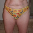 front view before surgery 