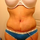 Scar post op 23. Incision irritated under BB.