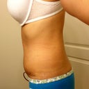 Scar post op 23